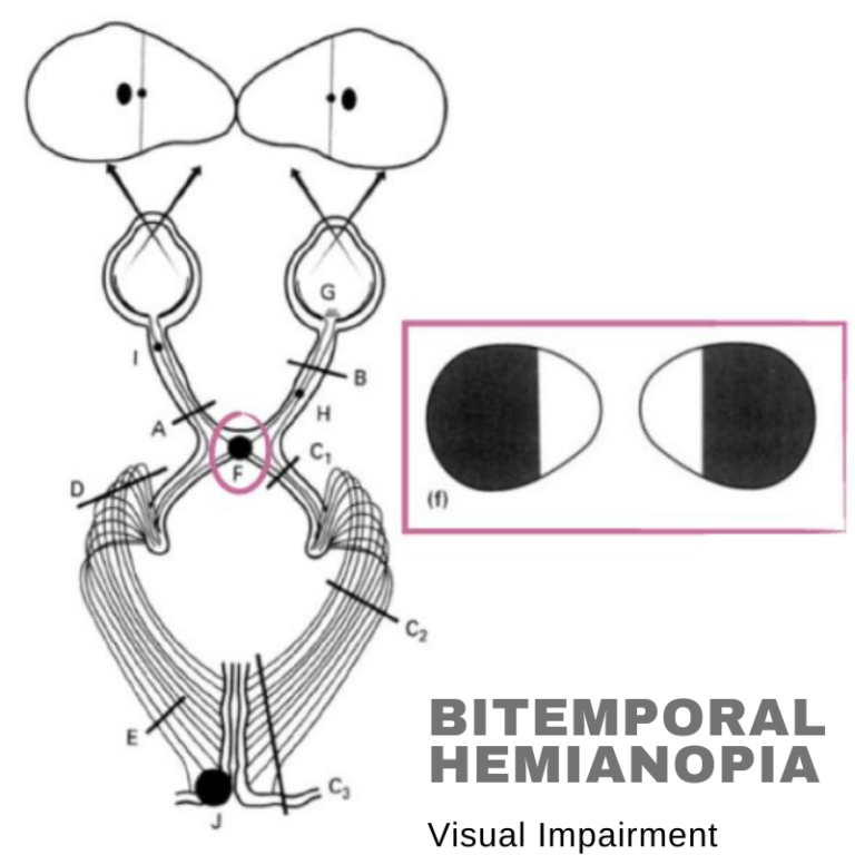 Bitemporal Hemianopia – Visual Impairment