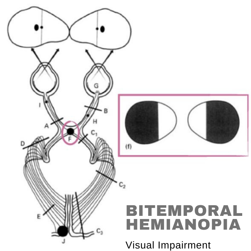 Bitemporal Hemianopia