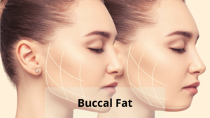 Buccal Fat