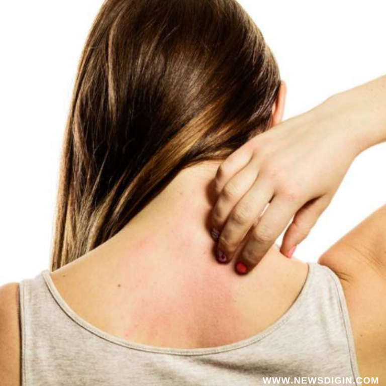 Skin Rash | Try These Ways For Solving Rash Problem