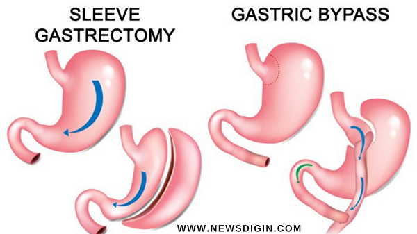 What Is Metabolic Surgery